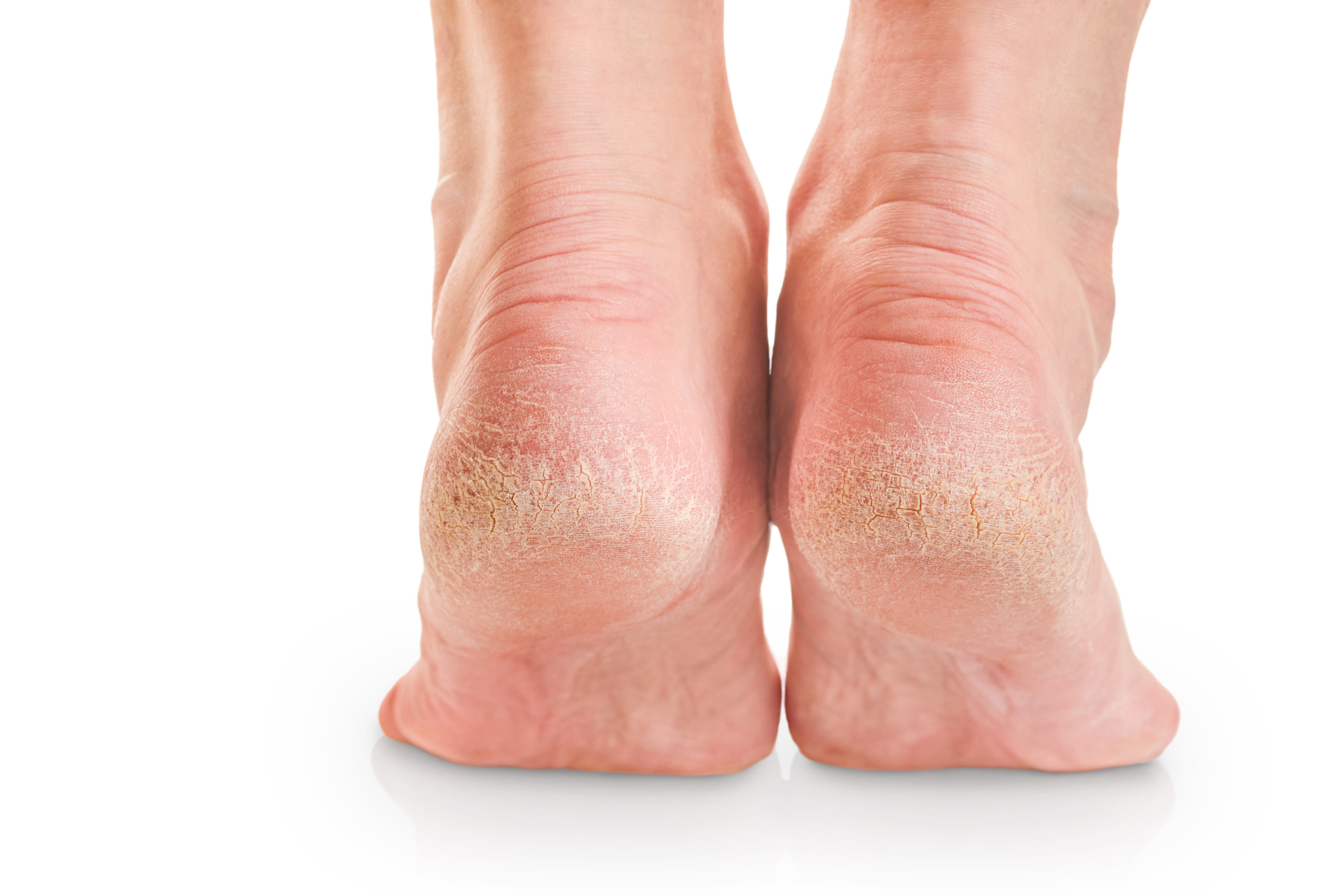 Cracked heel treatment